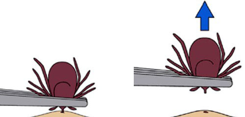 Clipart image showing how to remove an embedded tick with a pair of tweezers.
